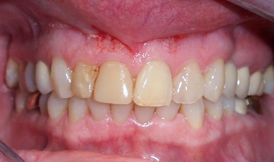 Picture of Patient #2 came in with discolored upper fillings and teeth. - Dr. James R. Mattingly DDS