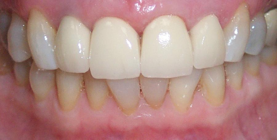 Picture of Patient #3 after deciding to even out his smile with a combination of porcelain veneers and crowns - Dr. James R. Mattingly DDS